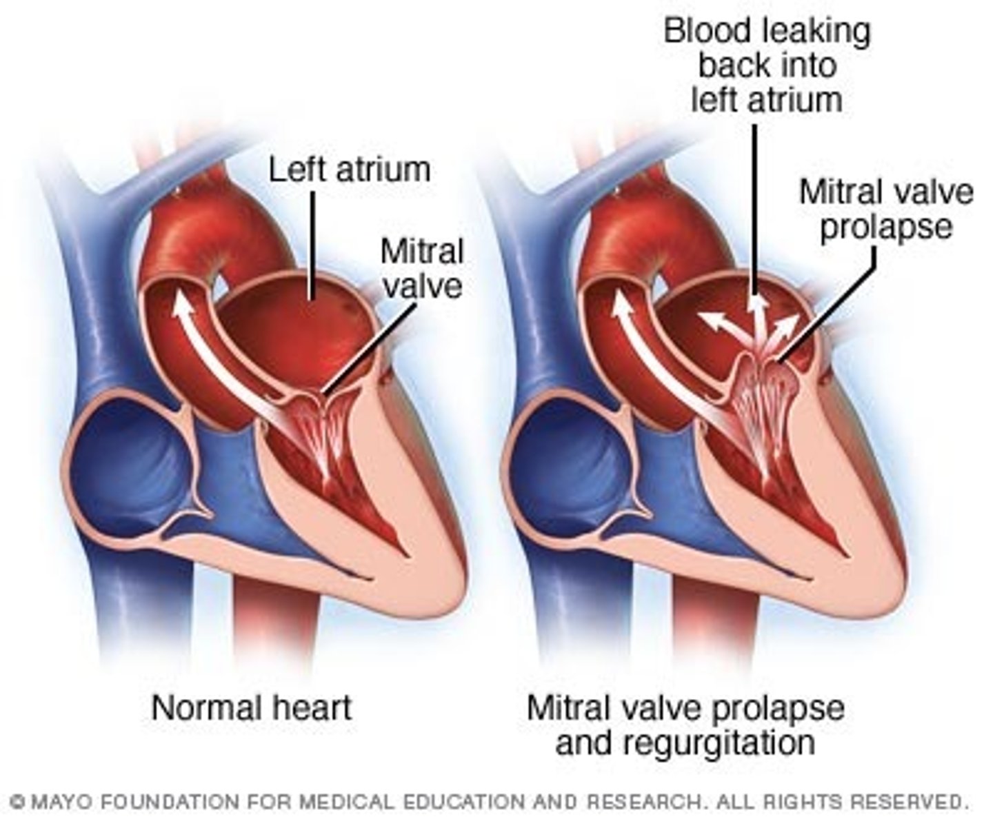 <p>A midsystolic ejection click is a cardinal finding of:</p>