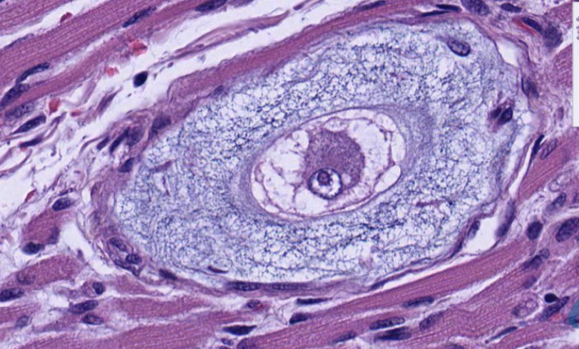 <p>This pathology is seen on a sample from a muscle biopsy. What is your diagnosis? </p>