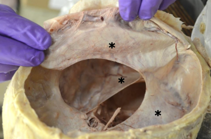 <p>projections of the dura mater that form septa to provide structure support</p>
