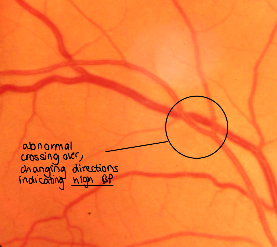<p>Can you describe an abnormal AV crossing and how it might occour?</p>