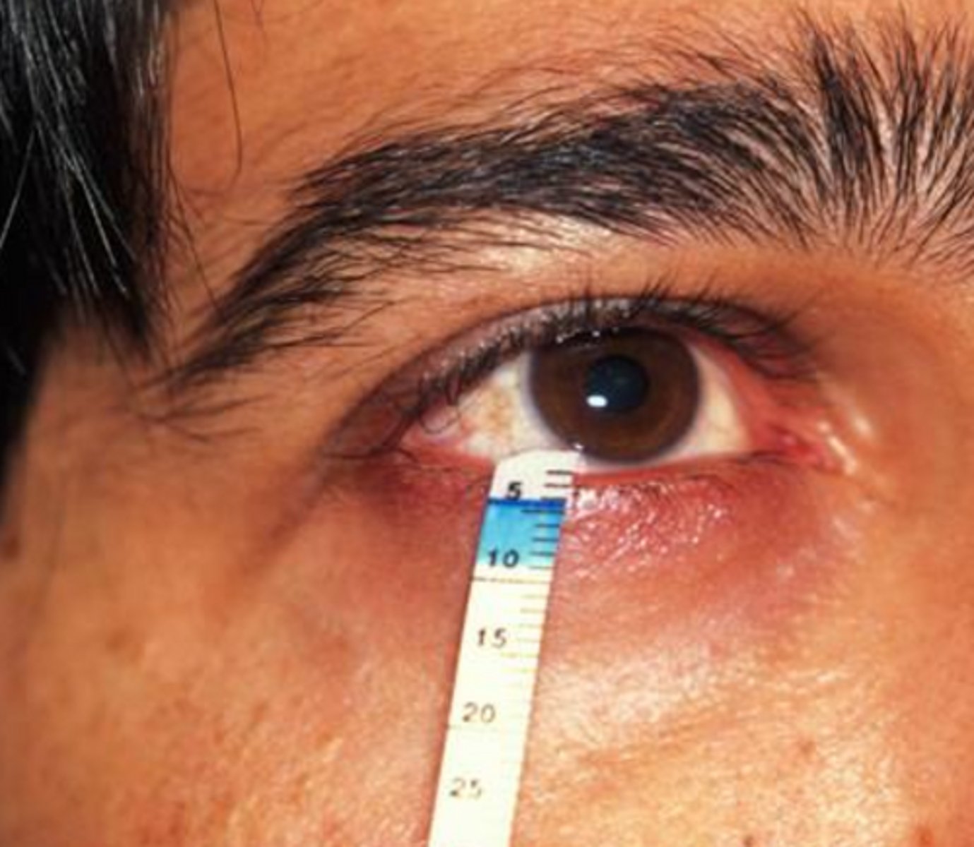 <p>what auto-immune salivary gland lesion involves using the Schrimer test to confirm decreased tear secretion?</p>