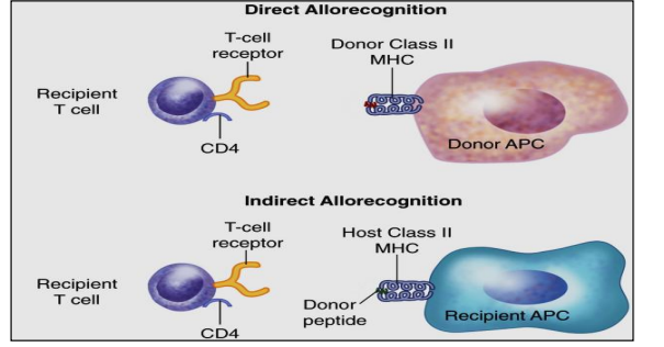 <p>RECIPIENT’s APCs migrate into allograft (transplanted) tissue and phagocytize donor antigen. </p><p>These recipient APCs display DONOR antigen to recipient T cells (recipient-recipient). This is a more important <strong>long-term </strong>mechanism that may cause rejection to occur over months to years.</p><p></p>