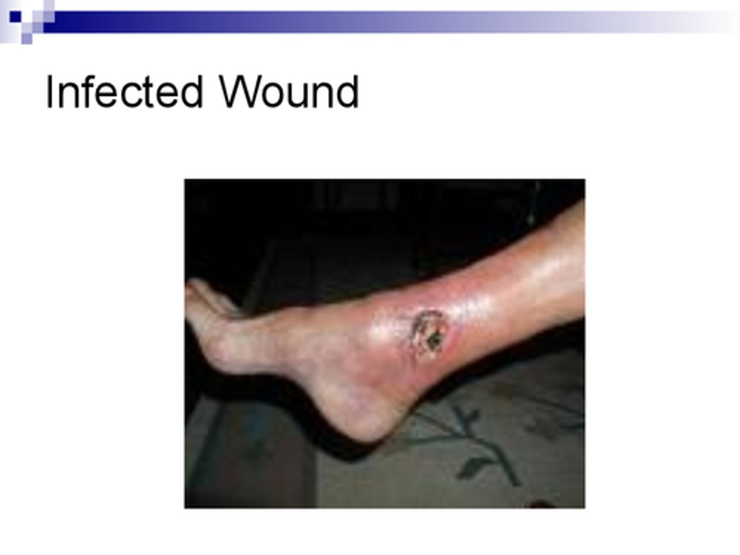 <p>CA: Pseudomonas aeruginosa <br>MOT: -direct contact of contamination to wound<br>Si/Sx: -inflammation -scabbing -green/blue pus <br>Dx: -wound cultures -PE -Hx -C+S<br>Tx: - Ciprofloxacin)</p>