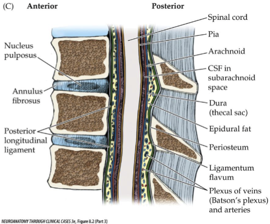 <p>Sensory or motor dysfunction caused by pathology of the nerve root.</p><p>Burning, tingling pain that radiates down a limb in the dermatome of the affected root</p><p>Chronic radiculopathy can result in atrophy and fasciculations</p><p>Common cause if disc herniation</p><p>– Nucleus pulposus extrudes through a tear in the annulus fibrosus</p>