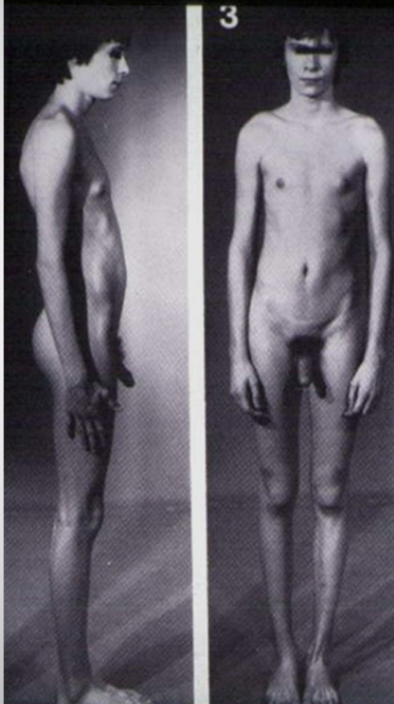 <p>Extra X chromosome in males leading to tall stature, long limbs, testicular atrophy, gynecomastia, infertility.</p>