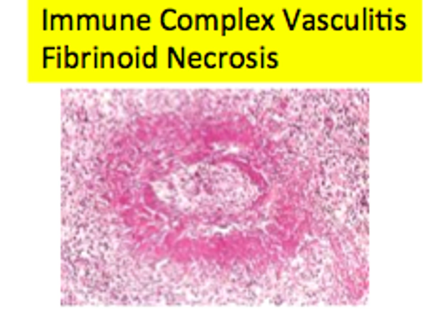 <p>complexes of antigens and antibodies deposited in the walls of arteries</p>