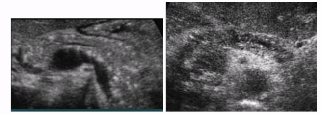 <ul><li><p><span style="background-color: transparent;">Calcifications </span></p></li><li><p><span style="background-color: transparent;">Can appear normal, usually more hyperechoic</span></p></li><li><p><span style="background-color: transparent;">Pseudocysts (25-40% of patients)</span></p></li></ul><p></p>