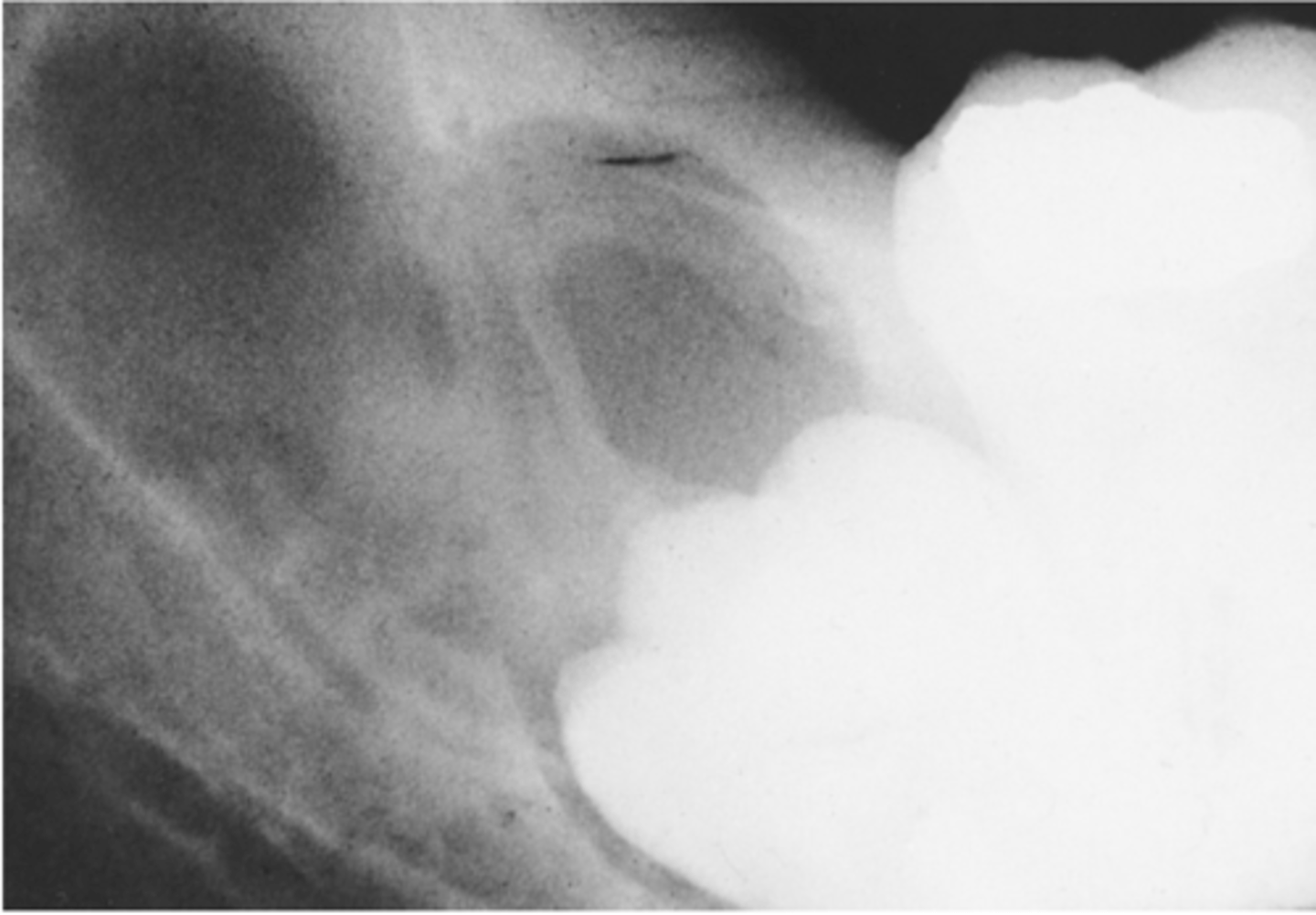 <p>The name of the benign tumor that is slow growing but locally aggressive and derived in association with an impacted tooth and dentigerous cyst is termed</p><p>A. calcifying odontogenic cyst.</p><p>B. odontogenic myxoma.</p><p>C. compound odontoma.</p><p>D. ameloblastoma.</p>