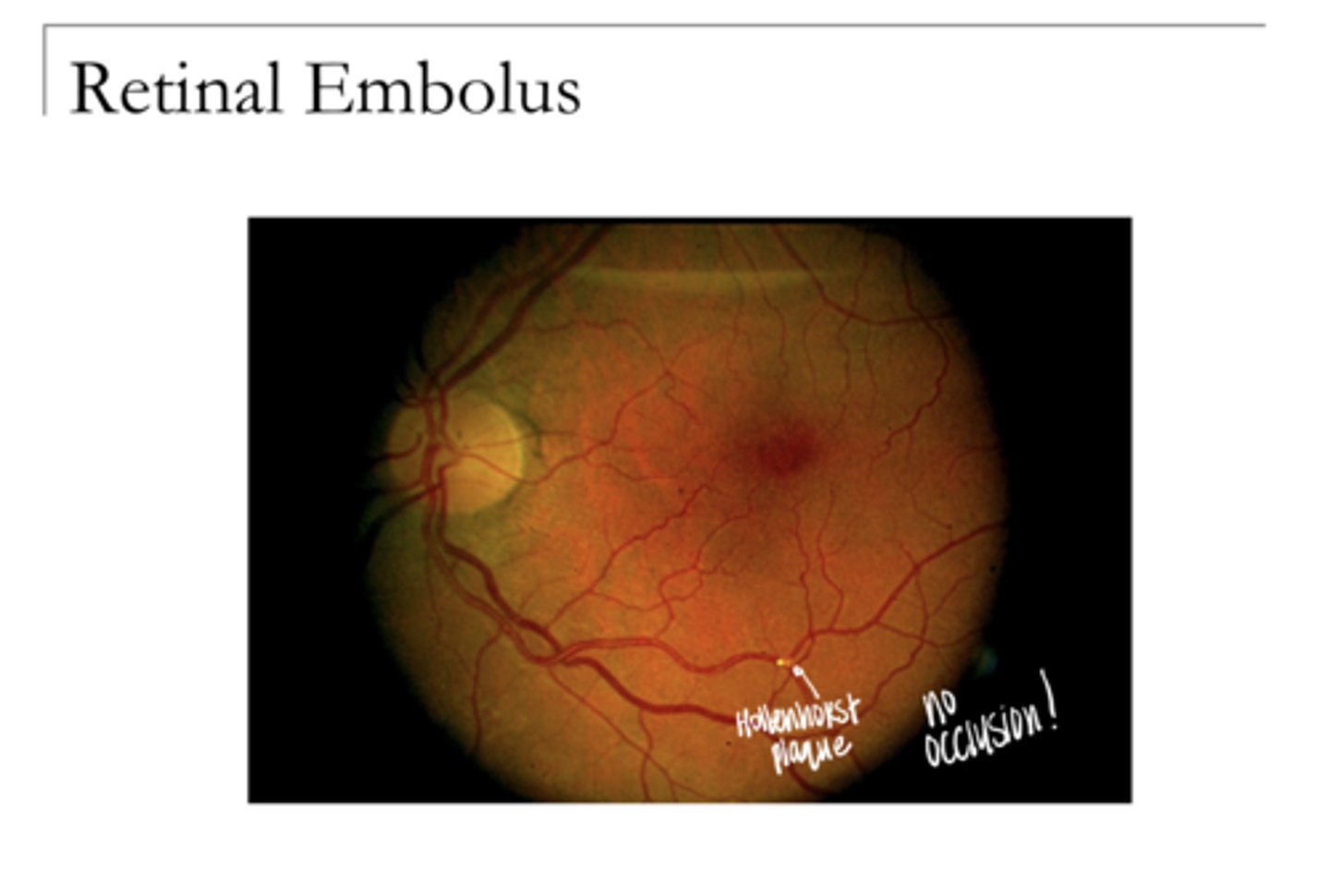 <p>Retinal Embolus -- Hollenhorst Plaque (Pic)</p>