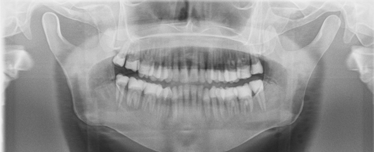 <p><span><span>·</span></span><span style="font-family: "Times New Roman"; line-height: normal; font-size: 7pt;"><span> </span></span><span><span>Anterior teeth appear skinny and out of focus</span></span></p>