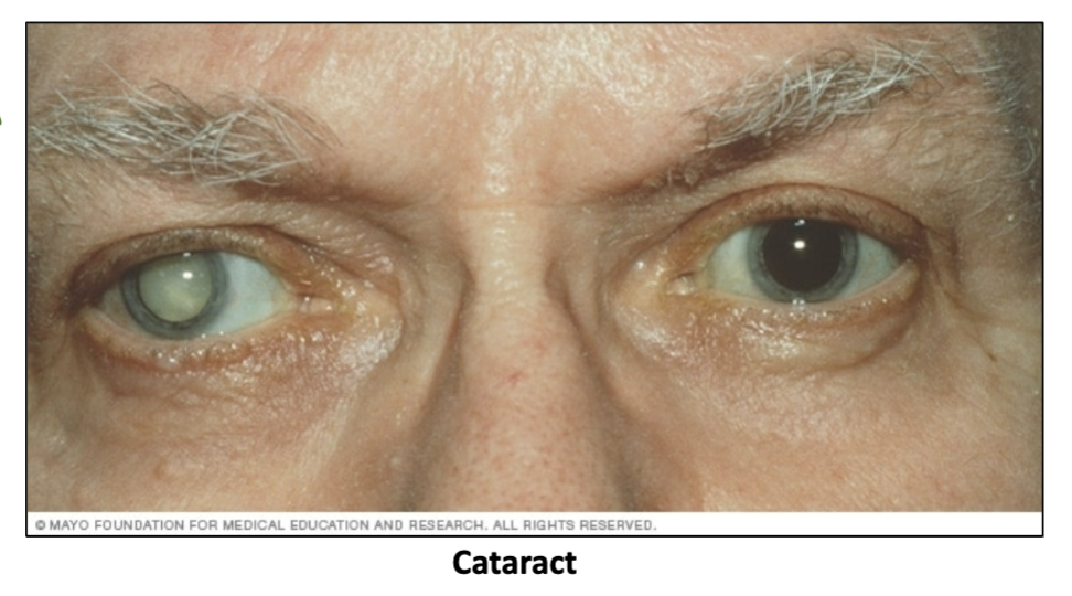 <p>Diabetes, smoking, drugs, <strong>ultraviolet radiation</strong>, and certain viruses</p>