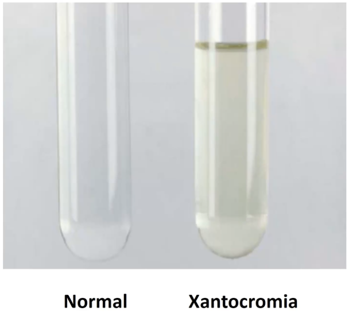 <p>Produtos de degradação da hemoglobina no LCR 12h após hemorragia subaracnoideia</p>