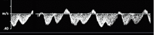 <p>is this a normal waveform seen in hepatic veins</p>