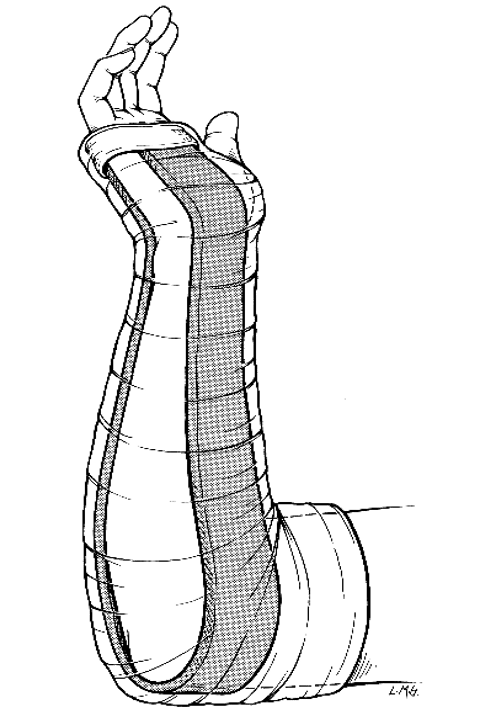 <p><strong>What are indications for forearm sugar tong splint?</strong></p>