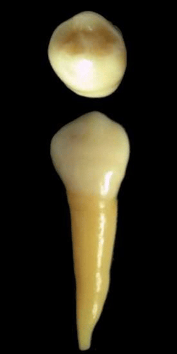 <p>what tooth is this &amp; why?</p>