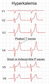 <p>Peaked T-waves and wide QRS (renal dysfunction)</p><p>tall peaked T waves - multiple leads&nbsp;</p><p>severe hyperkalemia&nbsp;</p>