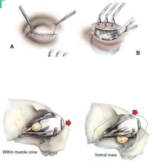 <p><span style="color: blue">Envolve remoção da conjuntiva, periórbita, músculos extraoculares e do bulbo ocular. O acesso transpalpebral pode ser utilizado associado, se necessário, com orbitotomia lateral (ressecção do arco zigomático).</span></p><p><span>Indicações: </span></p><ul><li><p><span style="color: green">Neoplasias orbitárias.</span></p></li></ul><hr><p><span style="color: blue">Técnica: </span></p><ul><li><p><span style="color: purple">Acesso transpalpebral</span></p></li><li><p><span style="color: purple">Pálpebras suturadas em padrão contínuo;</span></p></li><li><p><span style="color: purple"> Incisão periocular a 5mm das margens palpebrais;</span></p></li><li><p><span style="color: purple">Dissecção avança caudalmente por fora dos músculos extraoculares ejunto à órbita.;</span></p></li><li><p><span style="color: purple"> É removido no “bloco” cirúrgico:• Músculos extraoculares, bulbo ocular, conjuntiva, 3ª pálpebra eglândula lacrimal;</span></p></li><li><p><span style="color: purple">Se necessário, gordura e tecido conjuntivo remanescentes devem serremovidos;</span></p></li><li><p><span style="color: purple"> Nervo óptico e vasos são pinçados, seccionados e ligados com Nylon4.0;</span></p></li><li><p><span style="color: purple"> Sutura da conjuntiva em ponto contínuo nylon 4.0;</span></p></li><li><p><span style="color: purple">Aproximação do subcutâneo e por fim sutura da pele com Ny 4.0 empontos separados.</span></p></li></ul><hr><p><span>DESVANTAGENS DA EXENTERAÇÃO</span></p><ul><li><p><span>Maior espaço morto na região da órbita</span></p></li><li><p><span>Maior concavidade da região orbitária</span></p></li><li><p><span>Aspecto estético</span></p></li></ul>