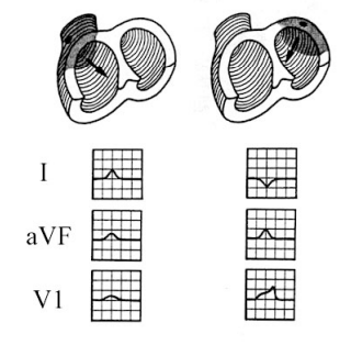 <p><strong>Atrial Sinus</strong></p><p>-Produces normal/abnormal _______ rhythms, showing if the SA node is firing regularly </p><p>-You can determine if the rhythm is sinus by seeing if the P wave is ________ in lead __ and if there is regularity in the beats with less than _ small boxes difference</p>