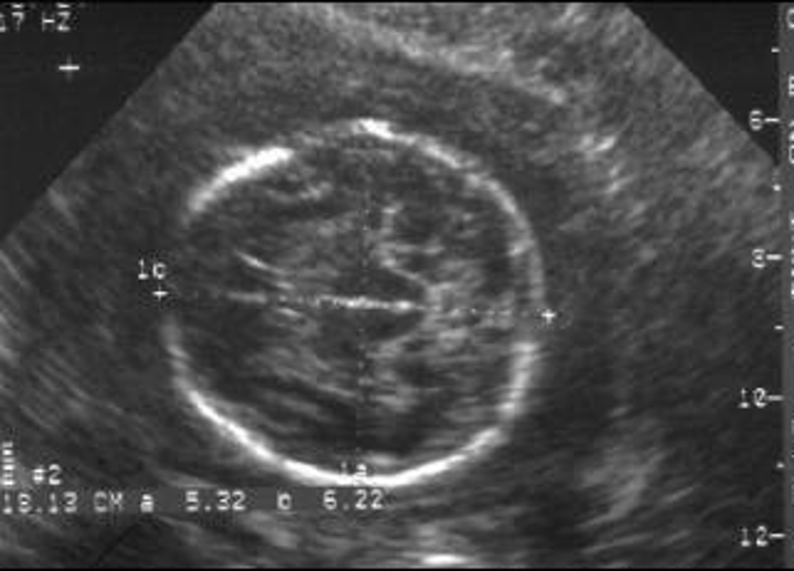<p>basketball shaped head</p><ul><li><p>round head shape with increased BPD and decreased OFD (head circumference) </p></li></ul>