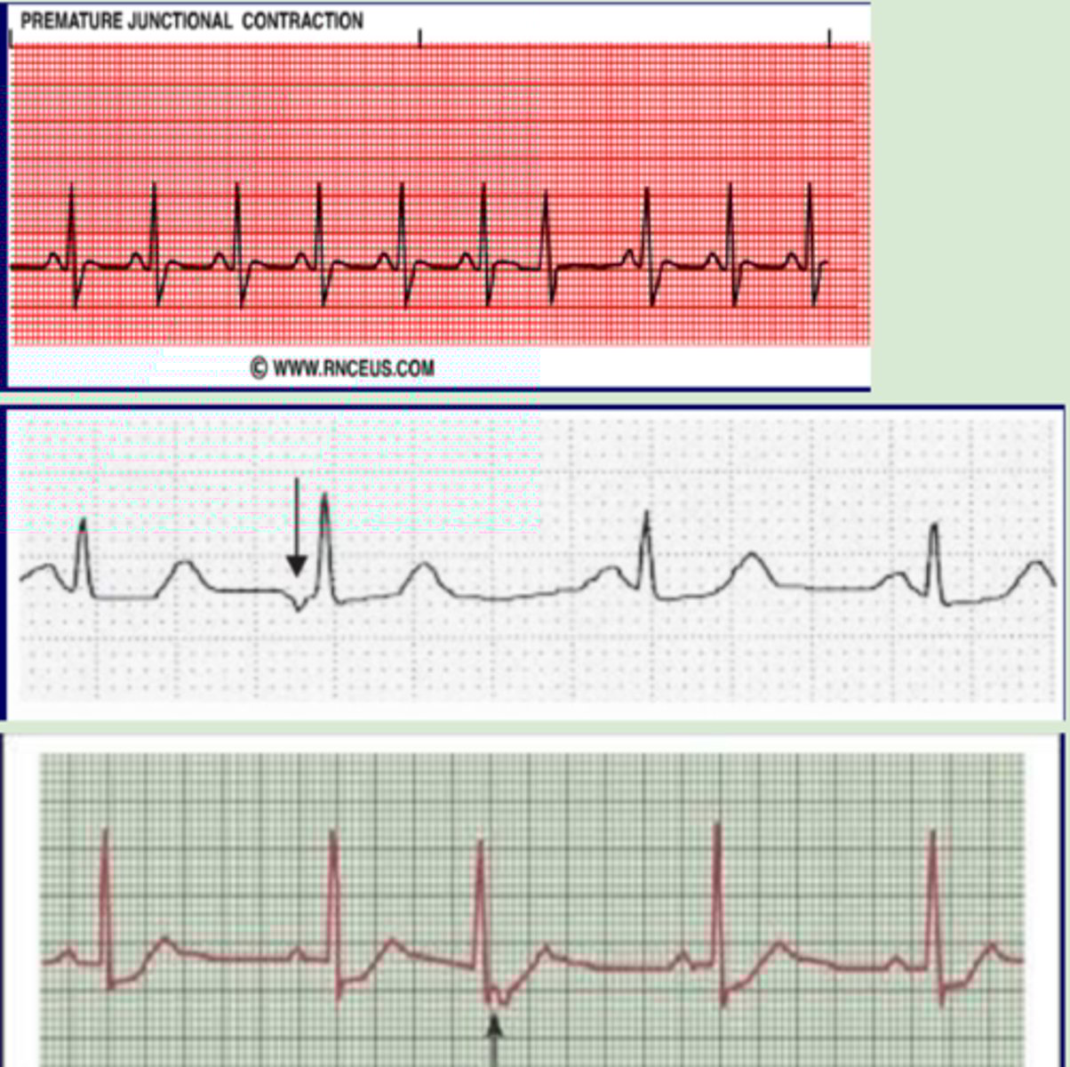 <p>Originate: AV node</p><p>QRS complex: narrow</p><p>P wave:</p><p>-None </p><p>-inverted before</p><p>-inverted after</p><p>Heart rate: 60-100 bpm until PJC</p><p>R-R intervals: regular until PJC</p>