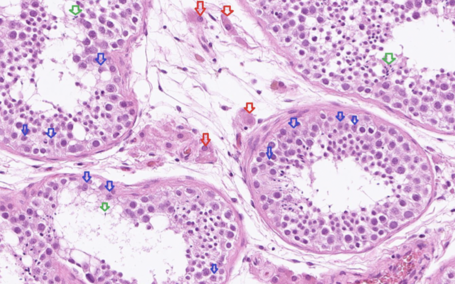 <p>Här produceras spermier. Här finns <strong>sertoliceller</strong> som stödjer utveckling från spermatogon till spermatozoa. I stromat finns <strong>leydigceller</strong> och <strong>myoidceller</strong>. </p><p>Röd: Leydigcell → rund cellkärna med liten nukleol. Rosa cytoplasma.  </p><p>Blå: Sertoliceller → har en tydlig nukelol, ligger vid basalmembranet och har en ljusare kärna. </p><p>Grön: Spermatozoa. </p>