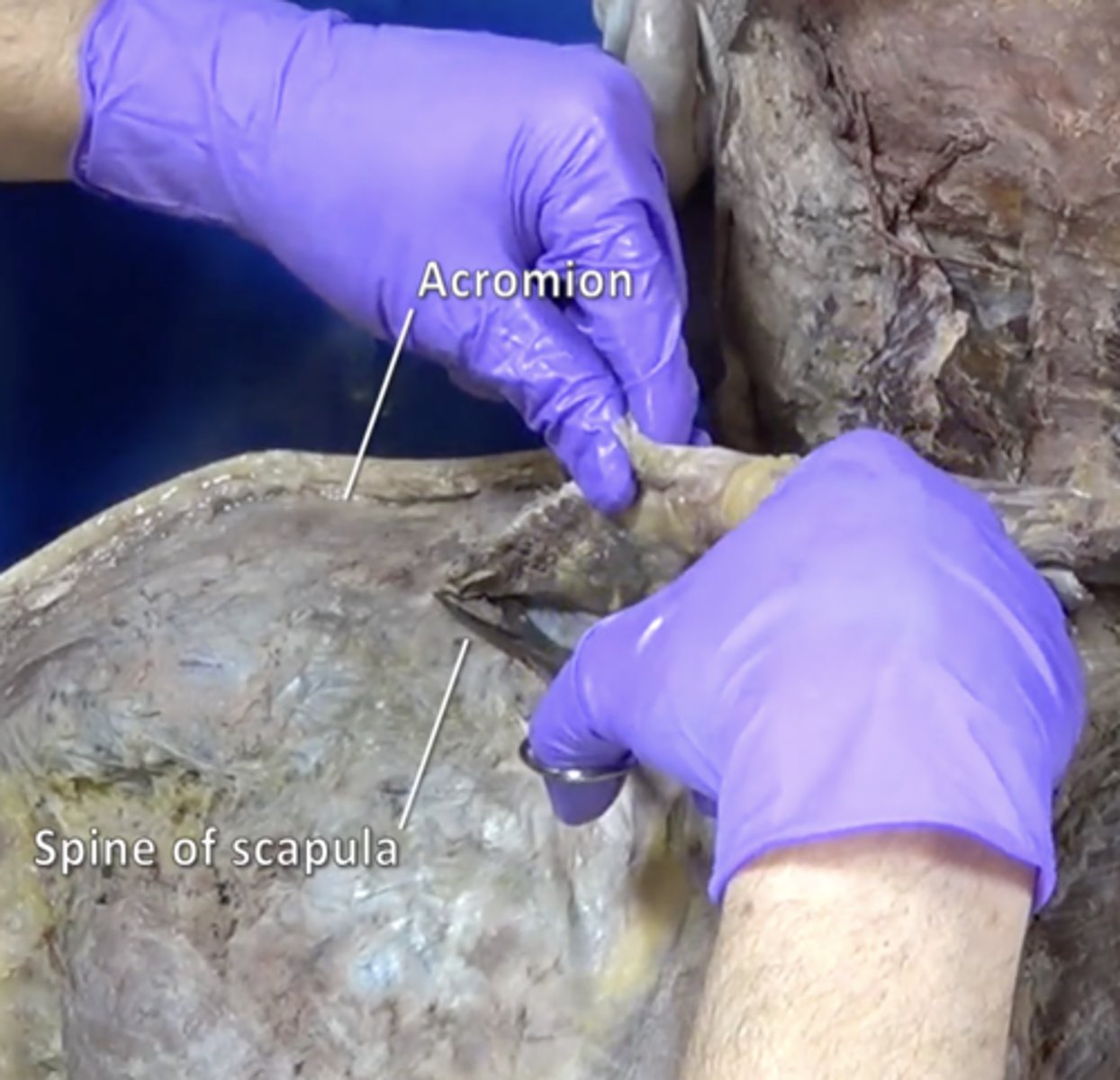<p>Outward extension of the shoulder blade forming the point of the shoulder.</p>
