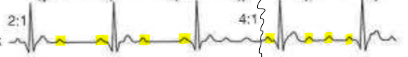 <p>What rhythm is present on the ECG?</p>