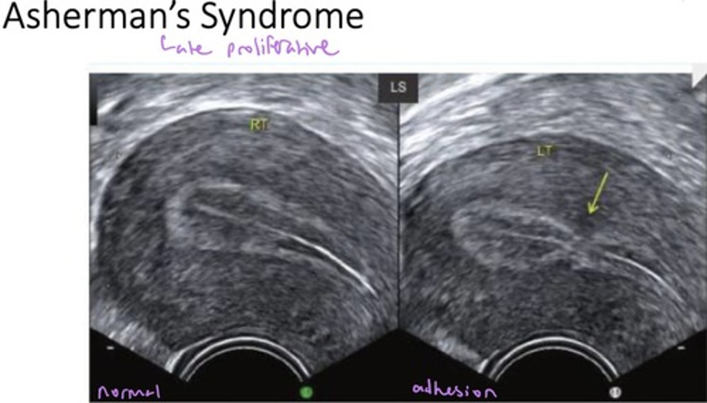 <p>Adhesions in the uterine cavity</p><p>Symptoms:</p><p>- normal/absent menses</p><p>- recurrent miscarriage</p><p>- infertility</p><p>- Trauma to basal layer causing scar tissue.</p>