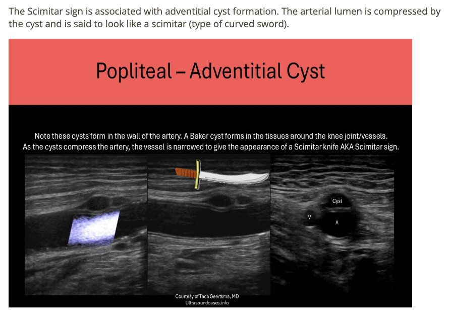 <p>d) adventitial cysts </p>
