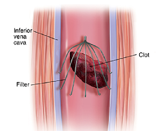<p>What is an IVC filter</p>