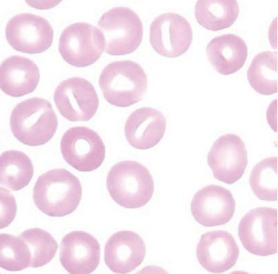 <p><span style="font-family: "Times New Roman", serif">RBCs with a mouth-like (slit-shaped) central pallor; associated with hereditary stomatocytosis or liver disease.</span></p>