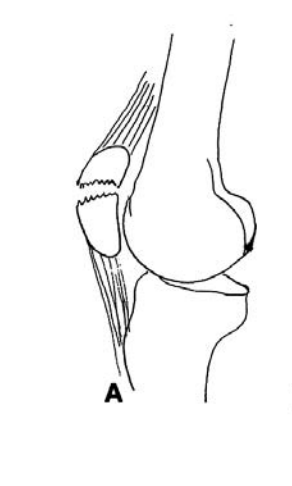<p>Indirect fractures Traction</p>