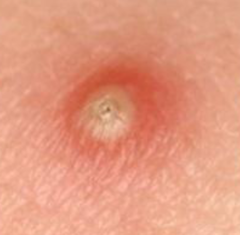 <p>variously sized elevation containing PUS </p>