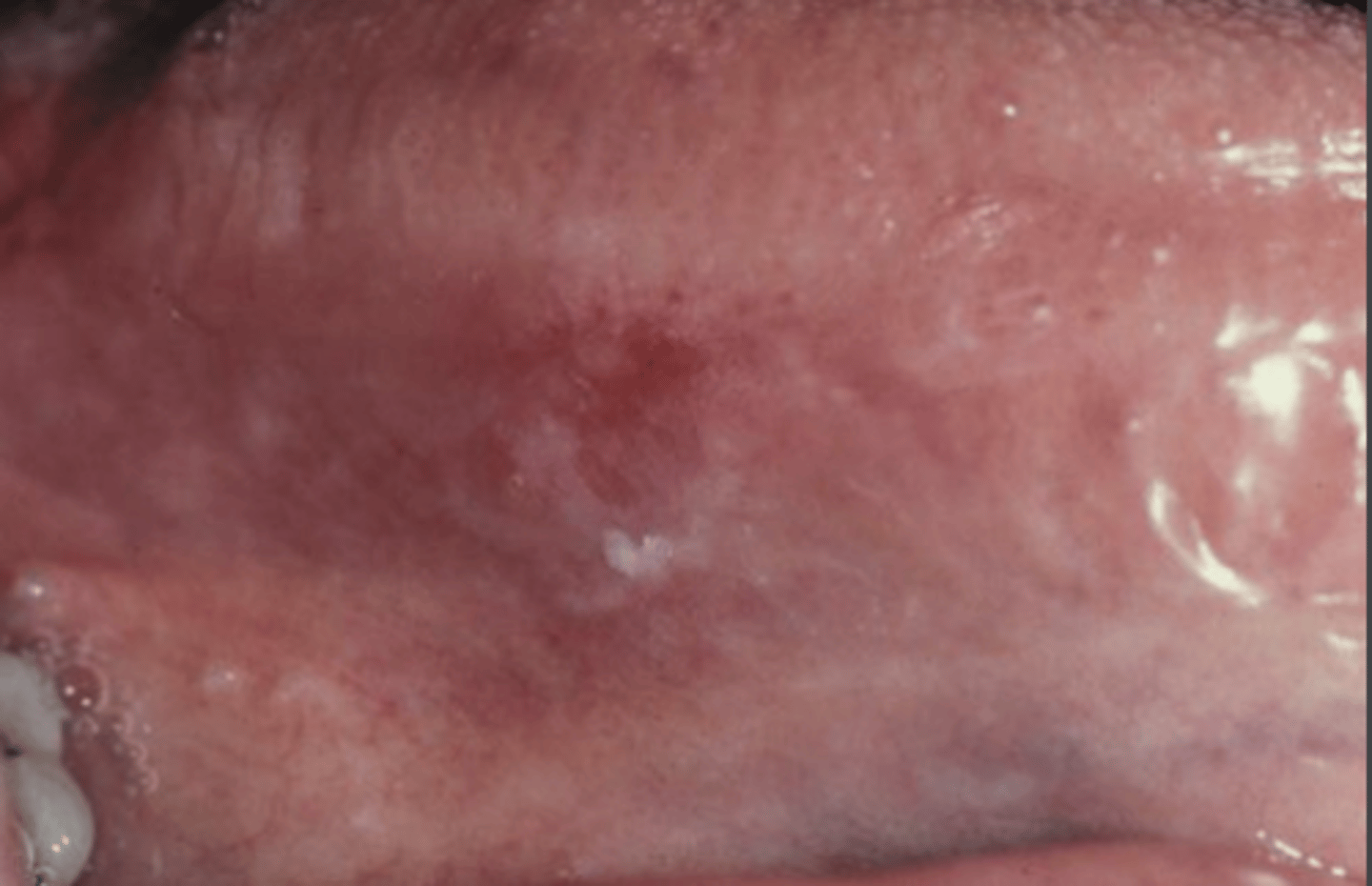 <p>Erythroplakia + Leukoplakia</p><p>Speckled/intermixed red and white lesions</p>