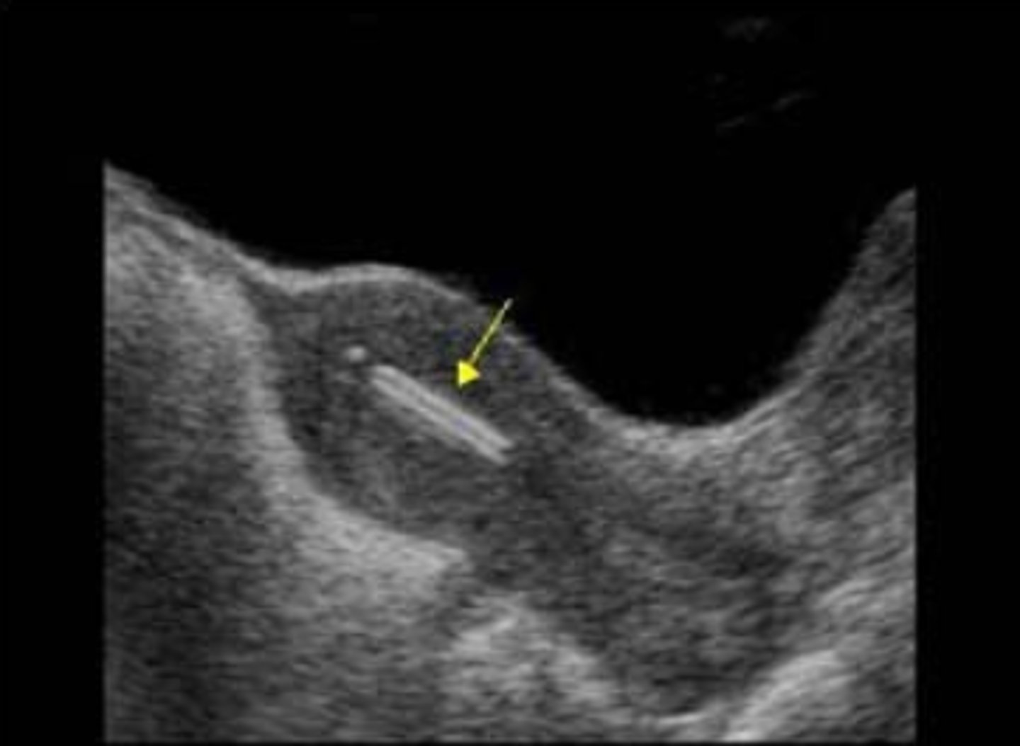 <p>ehkäisyväline</p>