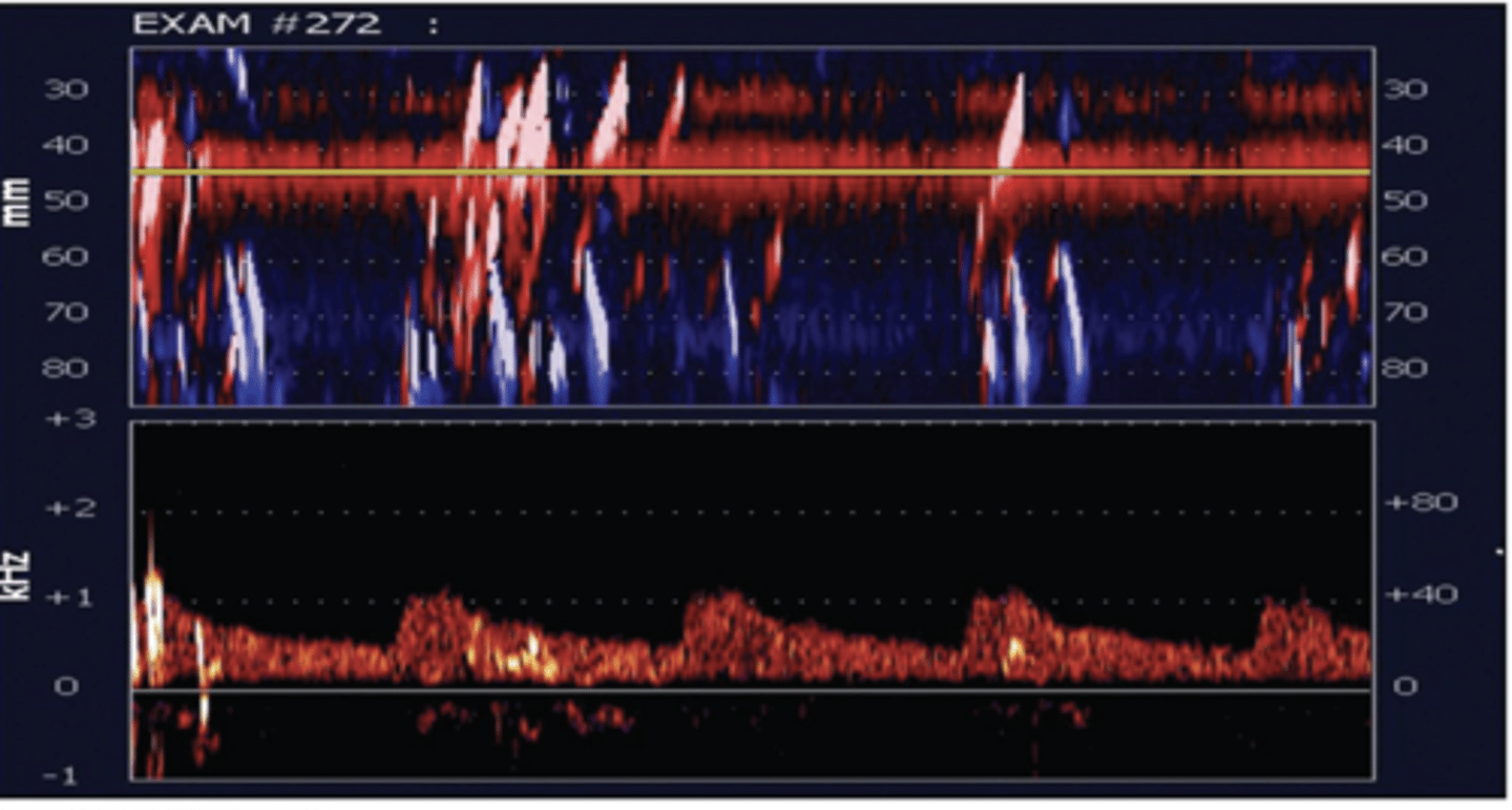 <p>Agitated saline with micorbbubles area seen as "hits" or microembolic signals (MES) during/after injection if a PFO is present</p><p>Perform valsalva if needed</p>
