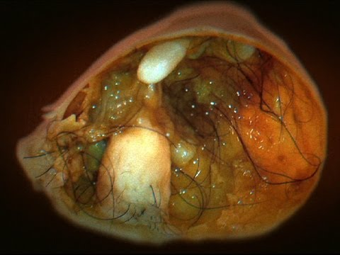 <p>What childhood cancer is this? </p>