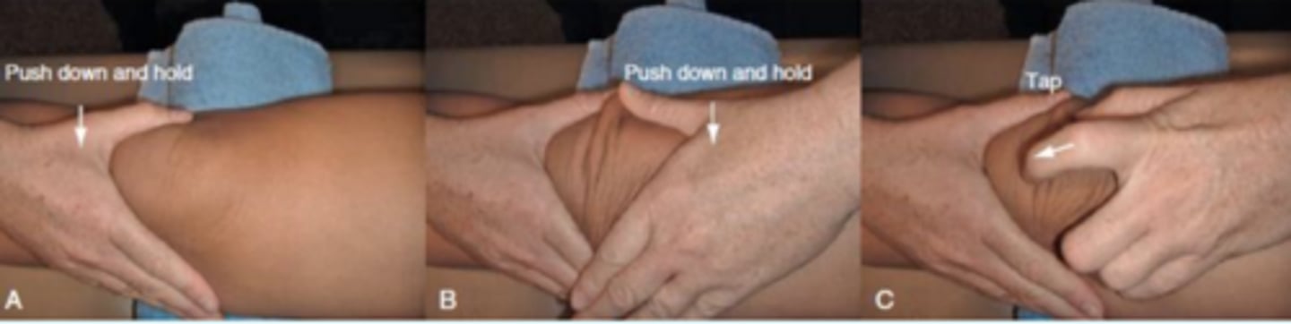 <p>- indicates infrapatellar effusion</p><p>procedure:</p><p>- pt's knee extended or flexed to discomfort, PT applies a slight tap or pressure over patella</p><p>(+): floating of the patella should be felt. this is sometimes called the dancing patella sign</p>