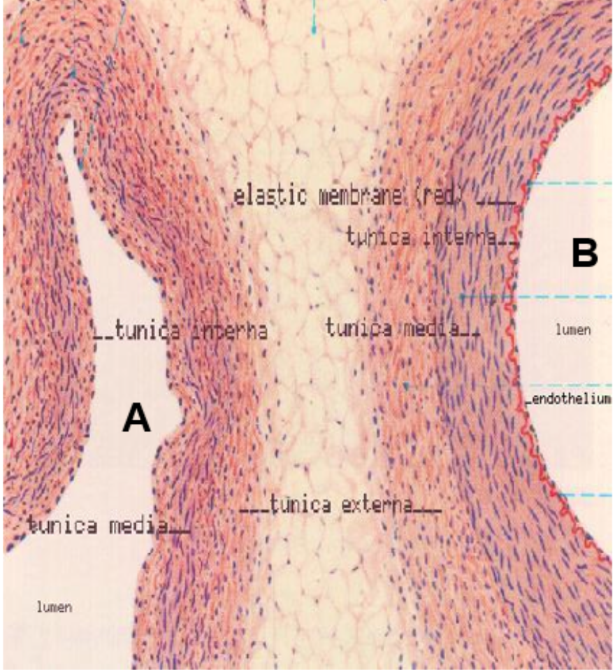 Which of the two vessels on this slide is an artery?