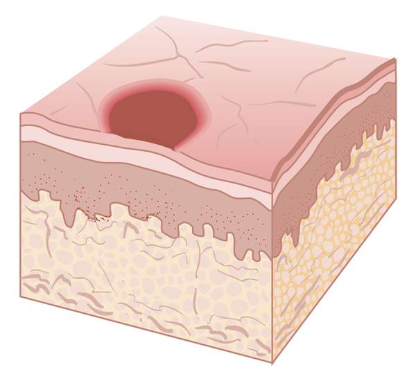 <p><span>is a flat area of color change and a non-palpable skin lesion</span></p>
