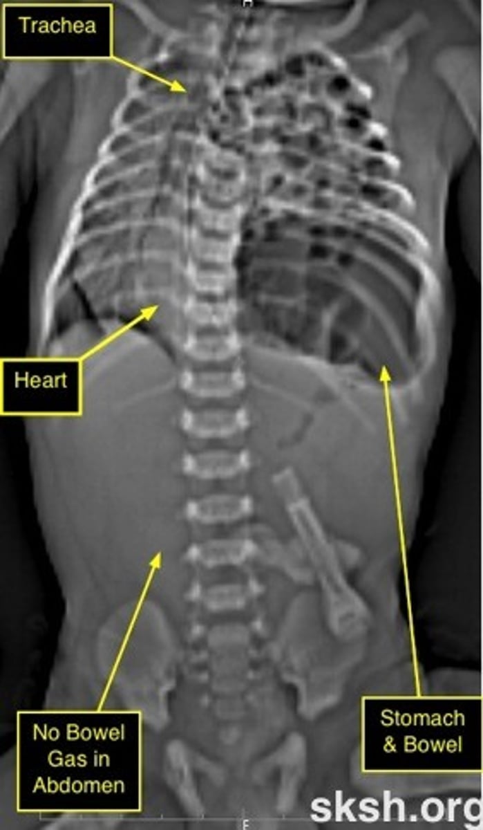 <p>Congenital diaphragmatic hernia (CHD)</p><p>- pulmonary hypoplasia</p><p>- pulmonary HTN</p><p>- 85% cases on the left abdominal viscera herniate into chest</p><p>- concave abdomen + barrel chest</p><p>- ER endotracheal intubation + gastric tube decompress stomach and bowel</p>