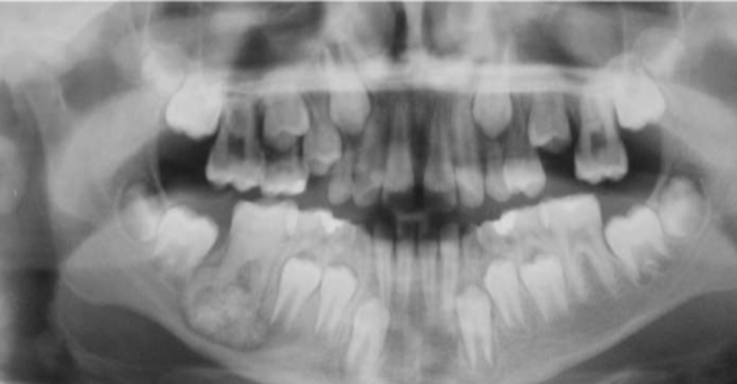 <p>Patient presents with pain and swelling. Radiograph shows a radiopaque mass fused to root of tooth surrounded by thin radiolucent rim, and some root resorption.</p>