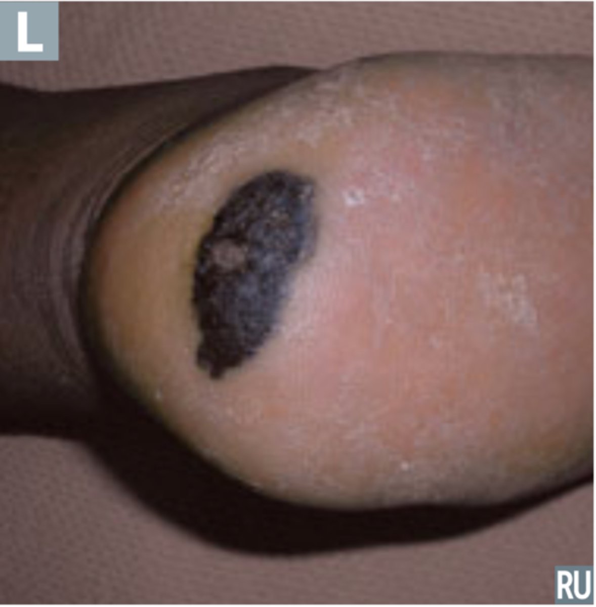<p>Melanoma that is more common in darker skinned individuals </p><p>Lesions are easy to miss </p><p>Palms, soles, subungal</p>
