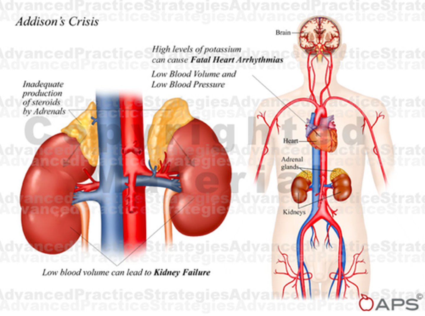 <p>N/V confusion, abdominal pain, extreme weakness, hypoglycemia, dehydration, decreased BP</p>
