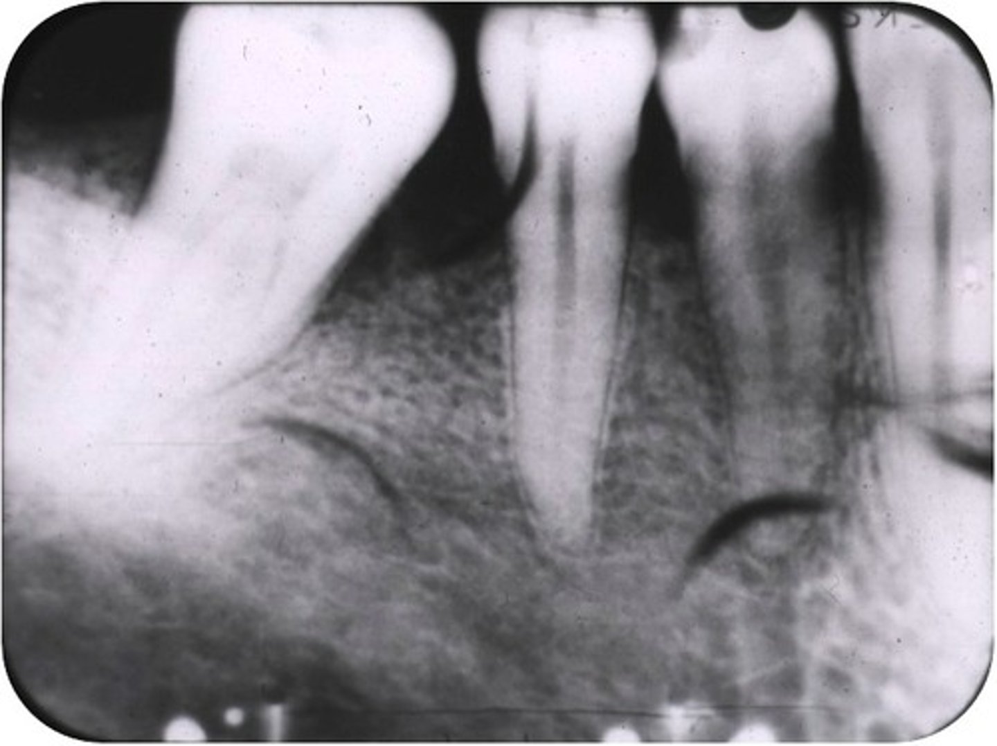 <p>Black crescent shaped marks/film emulsion damaged by operator's fingernail during rough handling.</p>