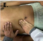 <p><span>is elicited in patients with acute cholecystitis by&nbsp;<strong>asking the patient to take in and hold a deep breath while palpating the right subcostal area</strong>. If pain occurs when the inflamed gallbladder comes into contact with the examiner's hand, Murphy's sign is positive.</span></p>