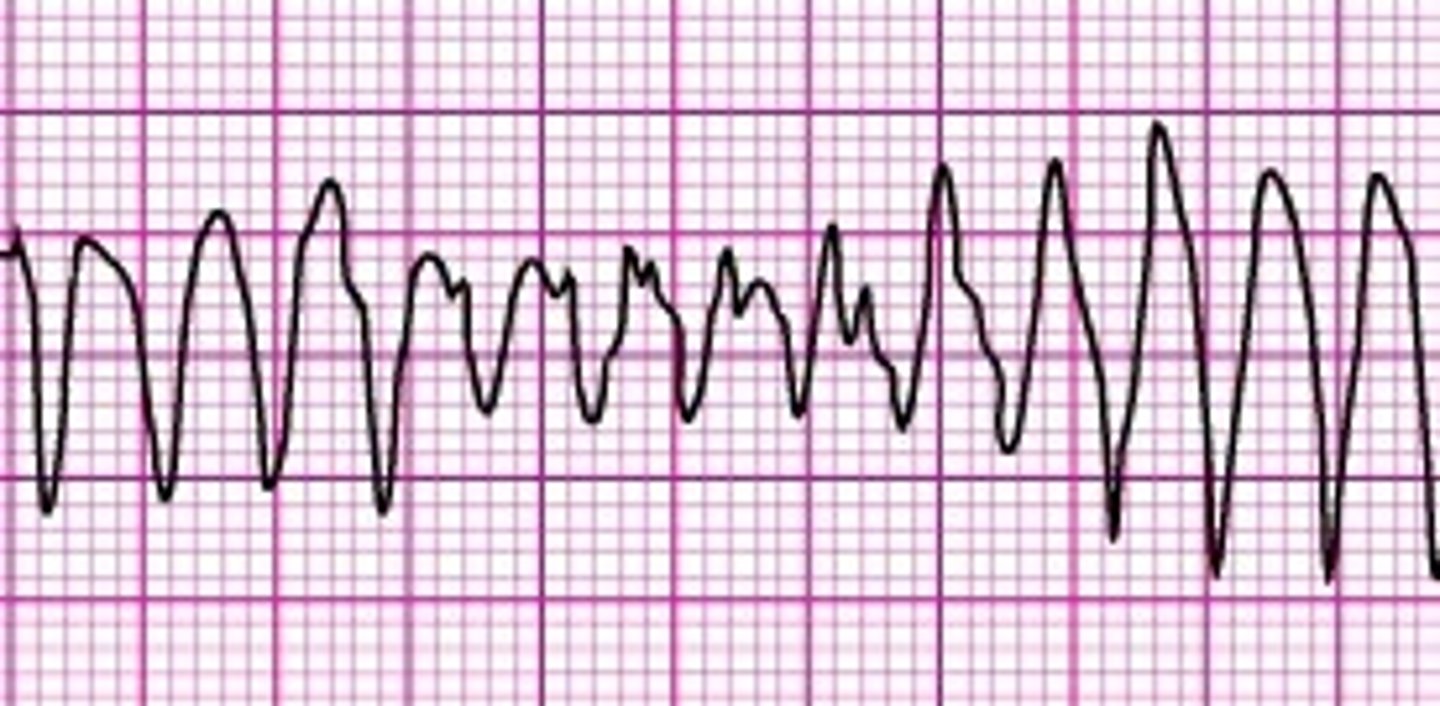 <p>Which Arrythmia is this?</p>