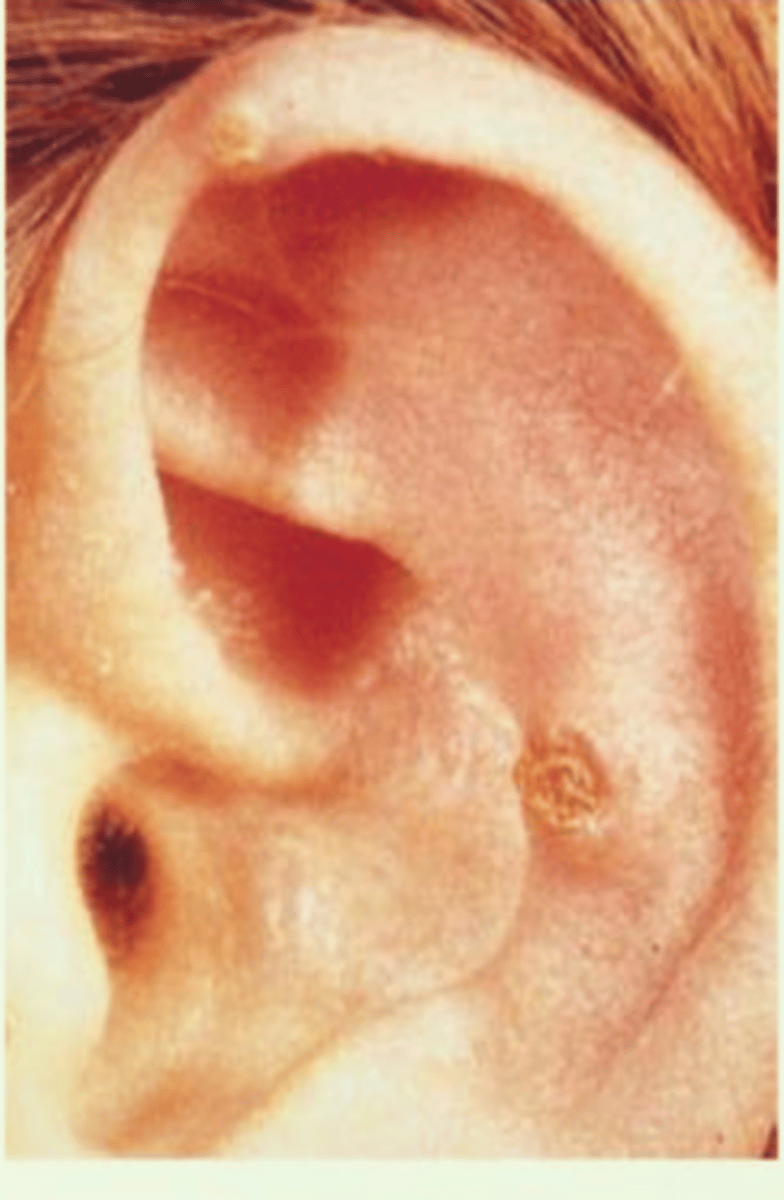 <p>Small lump on helix/antihelix</p><p>Associated with chronic RA</p><p>Possible ulceration</p>