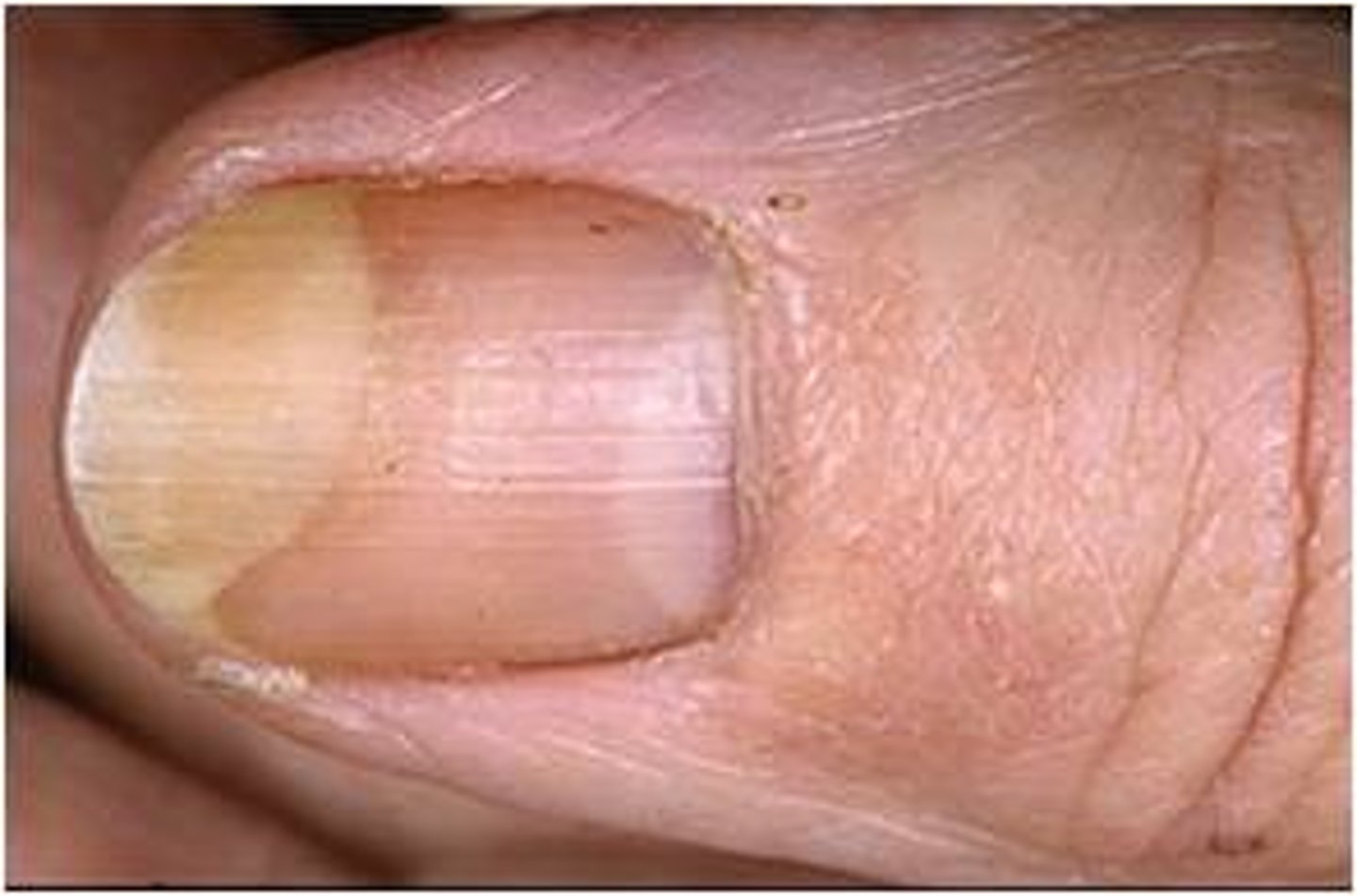 <p>Onycholysis; <span style="color: red"><strong>Irregular</strong></span> pitting.</p>