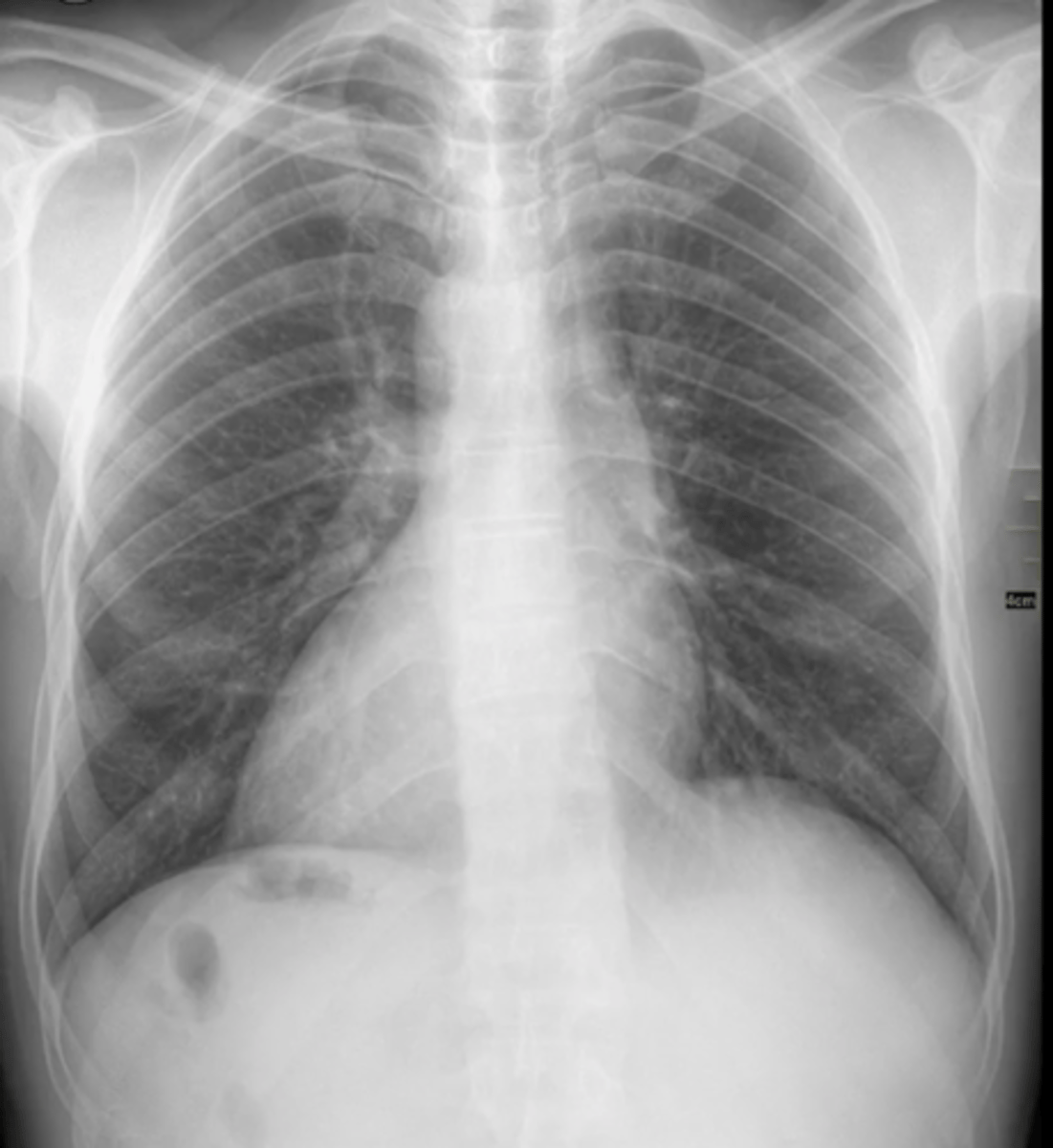 <p>(evaluating AP CXR) displacement of the heart to the right</p>